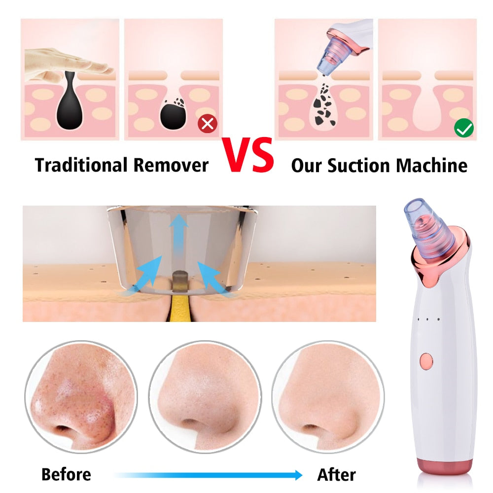 Blackhead Suction Device
