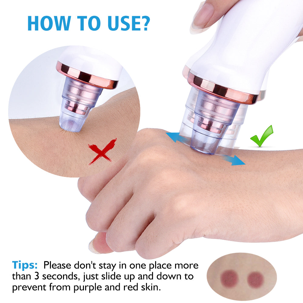 Blackhead Suction Device